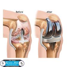 You Can Have Knee Replacement Surgeon Delhi At An Affordable Price And No Waiting Knee Replacement Exercises Knee Replacement Total Knee Replacement Exercises