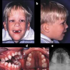 PDF) Palatal development of preterm and low birthweight infants compared to  term infants