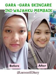 Perbandingan NPure dan Glad 2 Glow: Pilihan Skincare Terjangkau dan Efektif