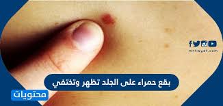 ينشأ الجدري نتيجة للعدوى بفيروس ينتقل . Ø¨Ù‚Ø¹ Ø­Ù…Ø±Ø§Ø¡ Ø¹Ù„Ù‰ Ø§Ù„Ø¬Ù„Ø¯ ØªØ¸Ù‡Ø± ÙˆØªØ®ØªÙÙŠ Ø§Ù„Ø§Ø³Ø¨Ø§Ø¨ ÙˆØ·Ø±Ù‚ Ø§Ù„Ø¹Ù„Ø§Ø¬ Ø¨Ø§Ù„ØªÙØµÙŠÙ„ Ù…ÙˆÙ‚Ø¹ Ù…Ø­ØªÙˆÙŠØ§Øª