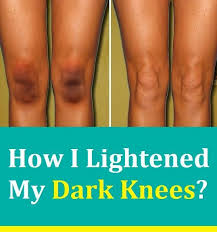 How to lighten dark knees and elbows? Dark Knees What Causes Them And How To Lighten Your Knees Lighten Dark Knees How To Lighten Knees How To Lighten
