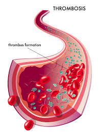 Blood clots can also form in healthy blood vessels when they aren't needed. Blood Clots American Blood Clot Association
