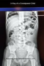 Pin On Alternatives To Miralax Natural Constipation Solutions