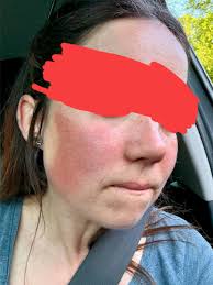 Hello, I'm looking for advice in regards to getting a diagnosis. I believe  I could have lupus as does my aunt who is a nurse, I have just seen a  rheumatologist and