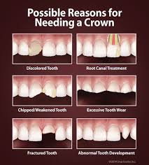 Dentaltown Possible Reasons For Needing A Crown Dental Dental Crowns Cosmetic Dentistry Veneers