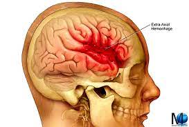 L'emorragia cerebrale è una condizione neurologica causata dalla rottura di un'arteria con conseguente diverse sono le cause che determinano emorragie cerebrali, tra le più comuni Emorragia Cerebrale Cause Sintomi Premonitori Diagnosi E Cura Medicina Online