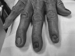 Image result for Koilonychia feet
