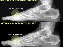 But a medial malleolus fracture is more often part of a compound injury involving one or both of the other ankle parts. Cheilectomy Preparation Recovery Long Term Care