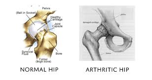 Hip pain has a number of causes, most of which are related to degeneration, injury, or inflammation of the muscles, bones, joints, and tendons located in the hip area. Total Hip Replacement Dr Peter Walker