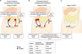 For many years scientists and if you are experiencing unusual bloating that lasts for more than three weeks, you should speak to your doctor to rule out the possibility of ovarian. Frontiers Are Epithelial Ovarian Cancers Of The Mesenchymal Subtype Actually Intraperitoneal Metastases To The Ovary Cell And Developmental Biology
