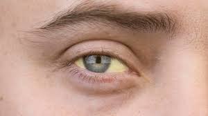 Augendiagnostik Krankheitssymptome Am Auge Ablesen