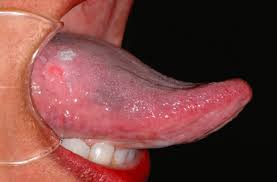 Image result for cancer of tongue