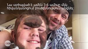 Boy, 11, has moles covering his WHOLE body because of a one-in-50,000  condition that caused him to develop a deadly brain tumour