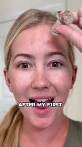 Favourite at-home micro infusion system!⭐️✨ #ubiskin #skincare  #acnetreatment #skintok #microinfusion #microneedling #fyp #skincaretips