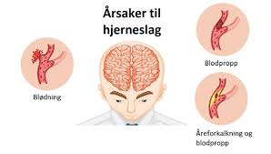 Jeppe bruun wahlstrøm video produktion: Antitrombotisk Behandling Etter Hjerneslag Forarsaket Av Hjerneblodning Nhi No