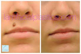 This Young Lady Had A Mole Removed From Her Upper Lip And Is Shown Before And Six Months After Her Procedure Moleremova Facial Plastic Mole Removal Upper Lip