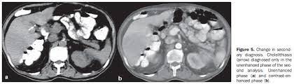 Unenhanced Ct Scan Meaning Ct Scan Machine