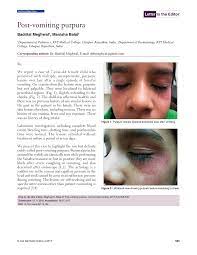 It is possible to notice widespread petechiae, which usually indicates an underlying serious disorder. Pdf Post Vomiting Purpura