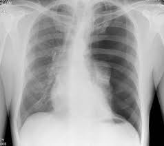 Depending on the cause of the pneumothorax, a second goal may be to prevent recurrences. Rcem Learning Thoracic Trauma Reference Material
