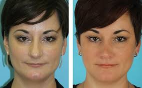 Bulbous Nasal Tip Before After Figure 1 Rhinoplasty Facial Rejuvenation Aesthetic Dermatology