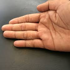 Jan 09, 2020 · use red skin potatoes so you don't have to mess with peeling potatoes while camping. Fingertips Peeling 5 Tips To Get Rid Of Peeling Skin From Fingertips India Com