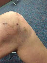 Severe Matting And Spider Veins After Sclerotherapy Treatment Of Several Reticular Veins Will This Go Away Photos