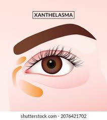 Image result for xantelasma
