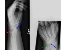 Image result for Lunate Dislocation
