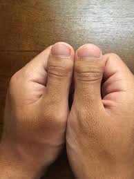 Check spelling or type a new query. What Is Clubbed Thumb