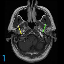Of course the amount of radiation is acceptable over being confined in a tube for me, i'm an avid. Left Sided Tinnitus No Iac Mass What Is The Next Step In The Diagnostic Algorithm Proscan Imaging