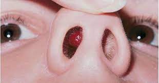 Bump On Nose Not Pimple Painful Hard Big White Bump Inside Nose Bump Inside Nose Pimple Inside Nose Nose Piercing Infection