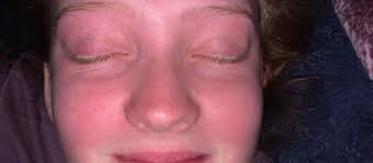 Does this look like a malar rash? This is in my 15 year old daughter