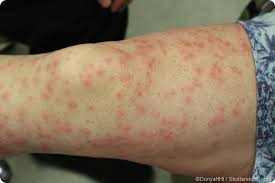 Image result for contact dermatitis