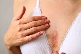Rash on Breast: When to Worry?
