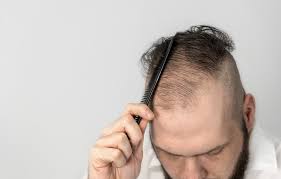 Finasteride the finasteride dose approved for hair loss was much lower: Top 3 Topical Finasteride Myths Miami Hair Institute