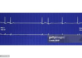 Image result for Extrasystole