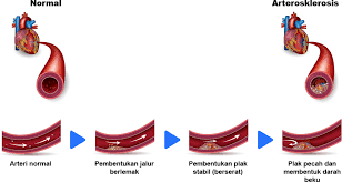 Dan berapakah bacaan kolesterol tinggi? Mengenai Kolesterol Tinggi My Health My Life