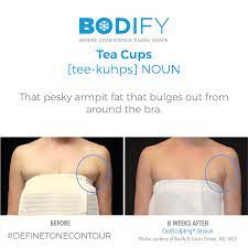 Pin On Coolsculpting