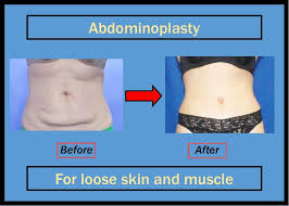 This Is An Abdominoplasty Performed By Board Certified Plastic Surgeon And Top Dr Malik Kutty M D In Houston Texas Abdominoplasty Plastic Surgeon Tummy Tucks