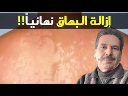 إزالة البهاق نهائيا تصبغ البشرة بسبب الشمس الحل الدكتور جمال الصقلي Youtube Incoming Call Screenshot