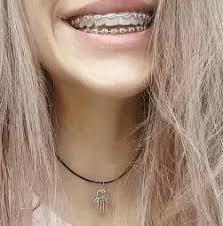 Patients wearing braces should always communicate their thoughts to their orthodontist to get their concerns addressed right away. Can You Still Get Braces With A Loose Tooth Quora
