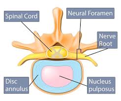 When one of these weakened discs shifts out of place and compresses nearby nerves, it is known as a bulging disc. The Difference Between Bulging Disc And Herniated Disc