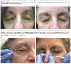 Image result for xanthelasma of eyelid