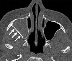 This is formed by lateral and posterior pneumatization of the most posterior ethmoid cells over the sphenoid sinus. The Preoperative Sinus Ct Avoiding A Close Call With Surgical Complications Radiology