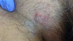 Once the virus has entered the body, it will either remain dormant in the nervous system without the. Derm Dx Itchy Rash On The Groin Clinical Advisor