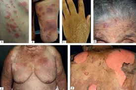 Image result for Pemphigoid