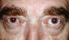 Uitpuilen van het oog naar voren uit de baan. Zur Differenzialdiagnose Des Exophthalmus Springerlink