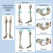 Image result for Femoral Retroversion