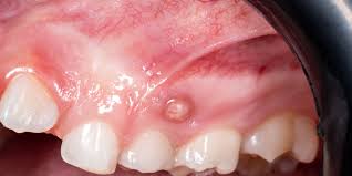 Image result for Periodontal Abscess