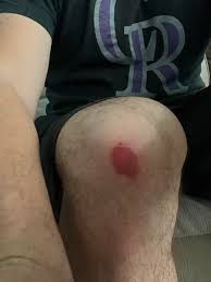 How to prevent mat burns on knees?